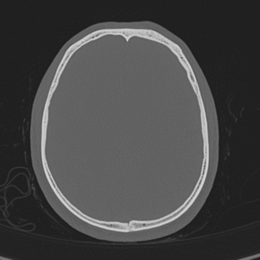 Normal CT skull (Radiopaedia 40798-43459 A 105).png