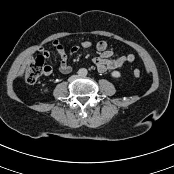 File:Normal CT split bolus study of the renal tract (Radiopaedia 48631-53634 Axial split bolus 159).jpg