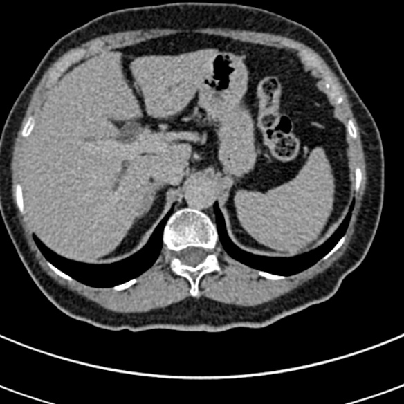 File:Normal CT split bolus study of the renal tract (Radiopaedia 48631-53634 Axial split bolus 8).jpg