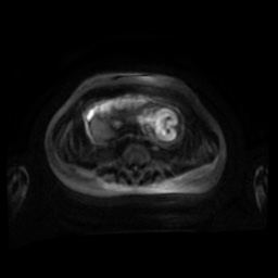 Normal MRI abdomen in pregnancy (Radiopaedia 88001-104541 Axial DWI 62).jpg
