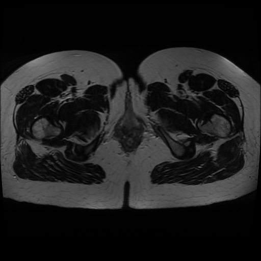 Normal MRI abdomen in pregnancy (Radiopaedia 88005-104548 Axial T2 53).jpg