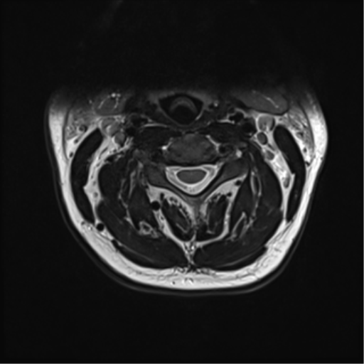 File:Normal MRI cervical spine (infection protocol) (Radiopaedia 53916-60039 Axial T2 20).png