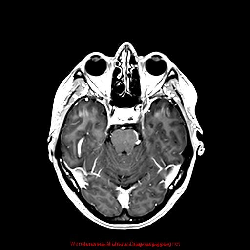 Normal adult brain MRI (non-enhanced and contrast-enhanced) (Radiopaedia 75262-86379 Axial T1 C+ 82).jpg