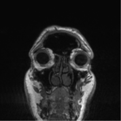 Normal brain MRI (non-focal epilepsy protocol) (Radiopaedia 53917-60040 Coronal T1 61).png