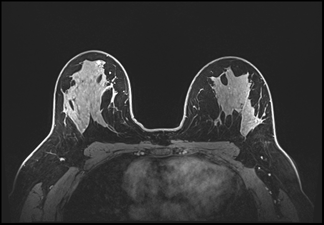 Normal breast MRI - dense breasts (Radiopaedia 80454-93850 C 132).jpg