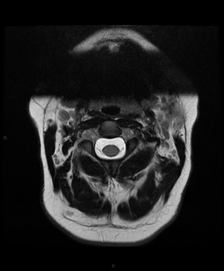 Normal cervical spine MRI (Radiopaedia 80146-93454 Axial T2 8).jpg