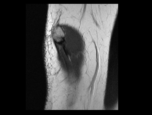 File:Normal elbow arthrograms (Radiopaedia 75550-86805 Sagittal PD 35).jpg