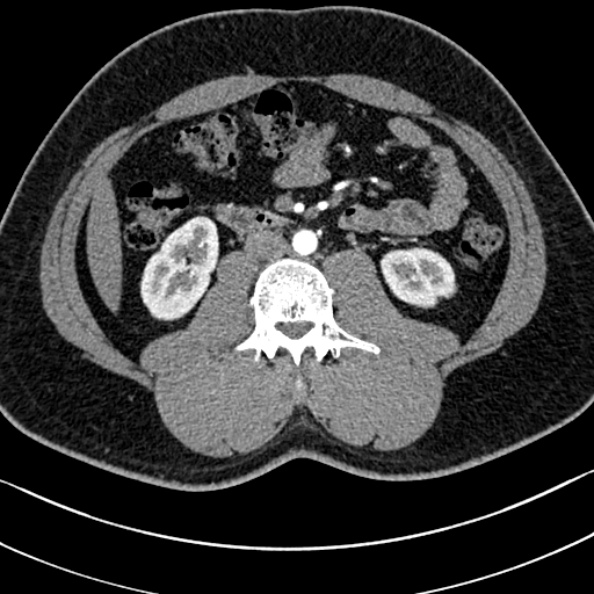 Normal kidneys on 4-phase CT study (Radiopaedia 25889-26038 B 62).jpg