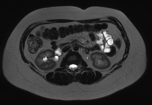 File:Normal liver MRI with Gadolinium (Radiopaedia 58913-66163 E 10).jpg
