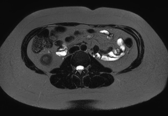 File:Normal liver MRI with Gadolinium (Radiopaedia 58913-66163 E 5).jpg