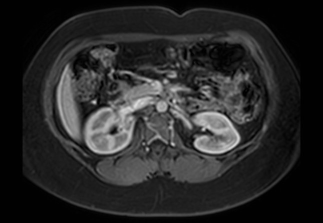 Normal liver MRI with Gadolinium (Radiopaedia 58913-66163 J 24).jpg