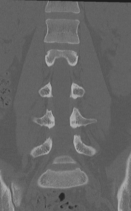 Normal lumbar spine CT (Radiopaedia 46533-50986 Coronal bone window 38).png