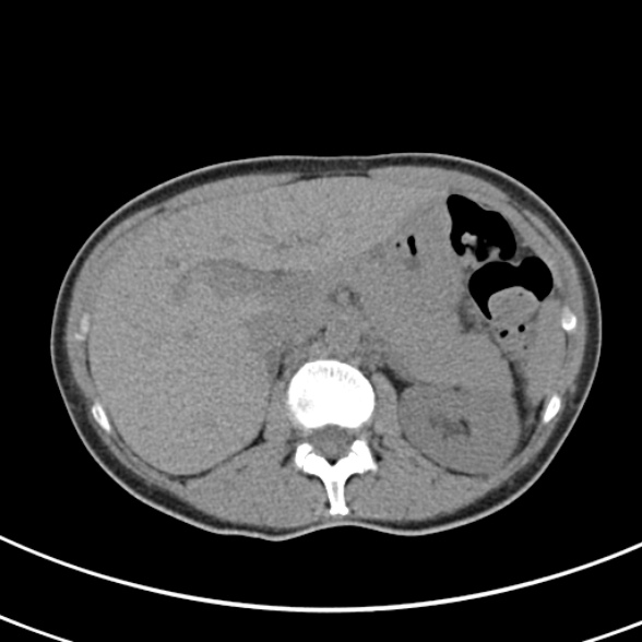 File:Normal multiphase CT liver (Radiopaedia 38026-39996 Axial non-contrast 21).jpg