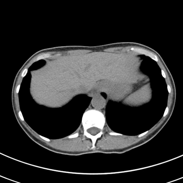 File:Normal multiphase CT liver (Radiopaedia 38026-39996 Axial non-contrast 8).jpg