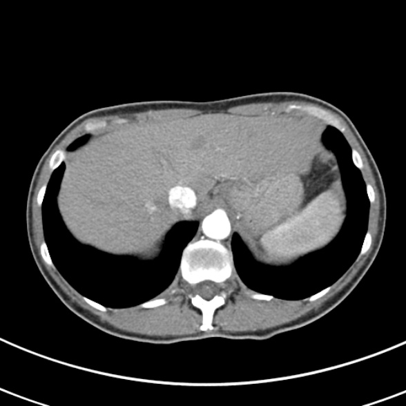 File:Normal multiphase CT liver (Radiopaedia 38026-39996 B 12).jpg