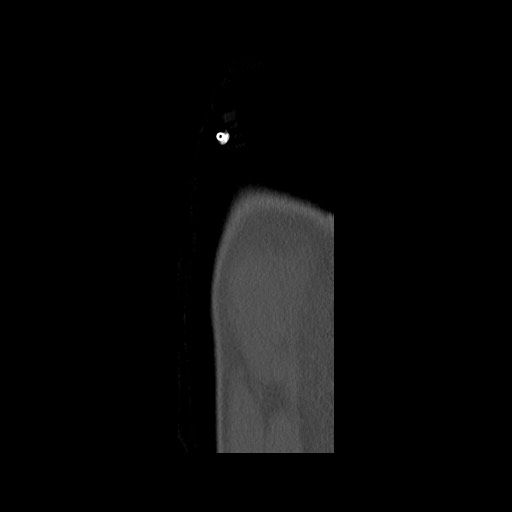 Normal pelvis (Radiopaedia 51473-57238 Sagittal bone window 148).jpg
