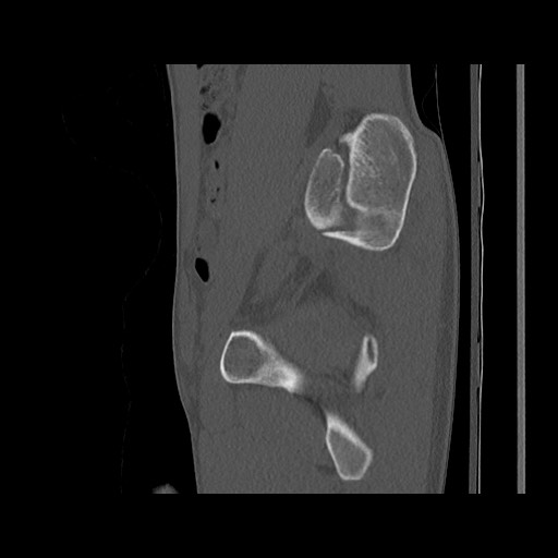Normal pelvis (Radiopaedia 51473-57238 Sagittal bone window 50).jpg