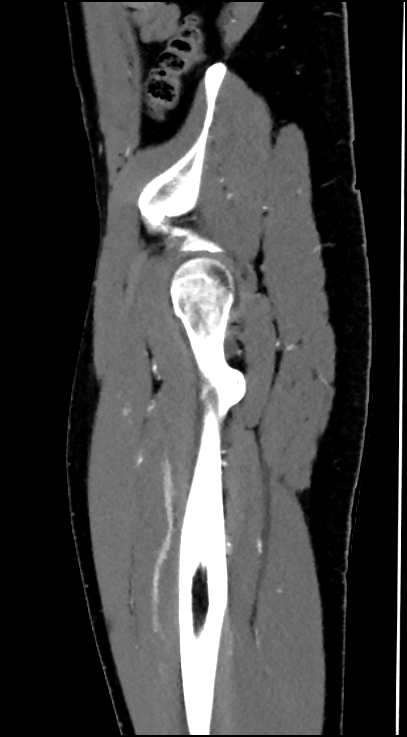 Normal pelvis CT angiogram (Radiopaedia 84966-100481 C 20).jpg