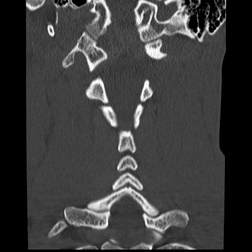 File:Normal trauma cervical spine (Radiopaedia 41017-43760 Coronal bone window 25).png