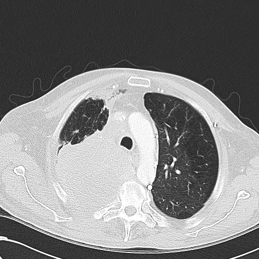 File:Obstructive superior vena cava tumor thrombus (Radiopaedia 28046-28306 Axial lung window 16).jpg