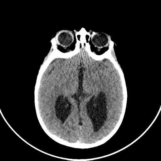 Occipital encephalocele (Radiopaedia 87339-103636 Axial non-contrast 39).jpg