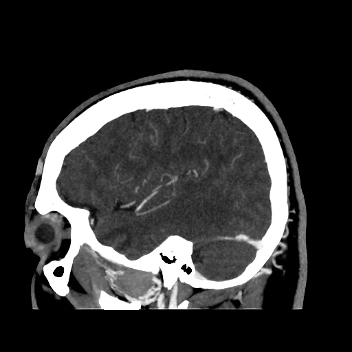 Occipital extradural hematoma simulating venous sinus thrombosis (Radiopaedia 46514-50964 D 19).jpg