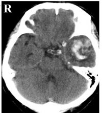 CT showing a cerebral contusion (and ICH) in the left temporal region