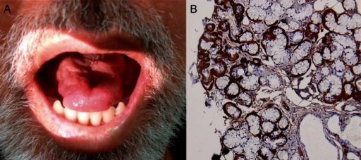 a)Tongue atrophy due to transthyretin-related familial amyloid polyneuropathy(synonym [15]) b)minor salivary gland biopsy