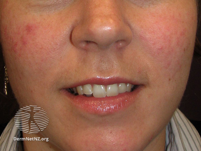 Rosacea (DermNet NZ acne-red-face-3630).jpg