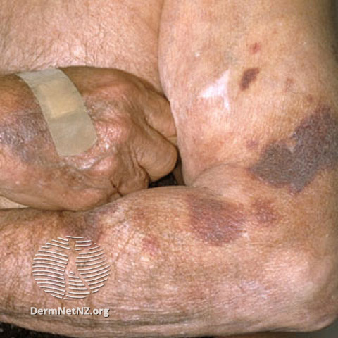 File:Steroid purpura (DermNet NZ vascular-s-purpura5).jpg