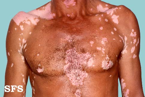 File:Vitiligo (Dermatology Atlas 1).jpg