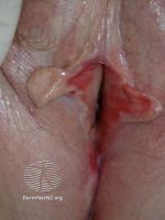 File:Vulval lichen planus (DermNet NZ 2390-s2).jpg
