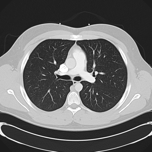 File:'Bovine' aortic arch (Radiopaedia 33554-34637 Axial lung window 25).png