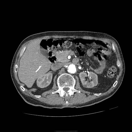 Abdominal aortic aneurysm (Radiopaedia 13341-13340 Axial C+ arterial phase 66).jpg
