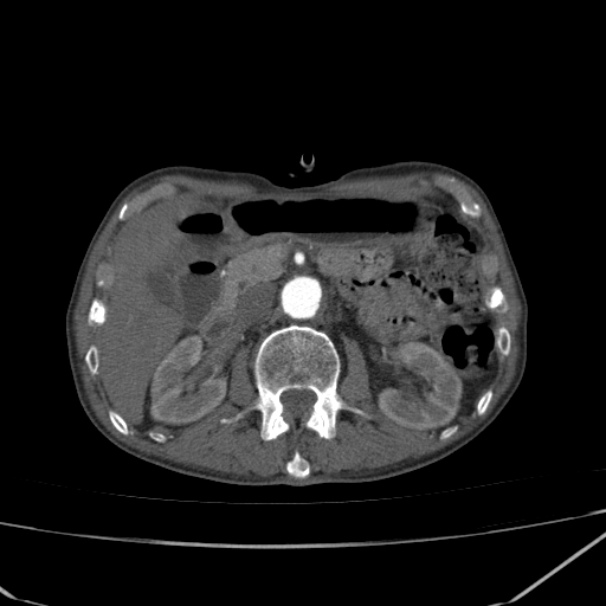 Abdominal aortic aneurysm (Radiopaedia 23703-23856 Axial C+ arterial phase 26).jpg