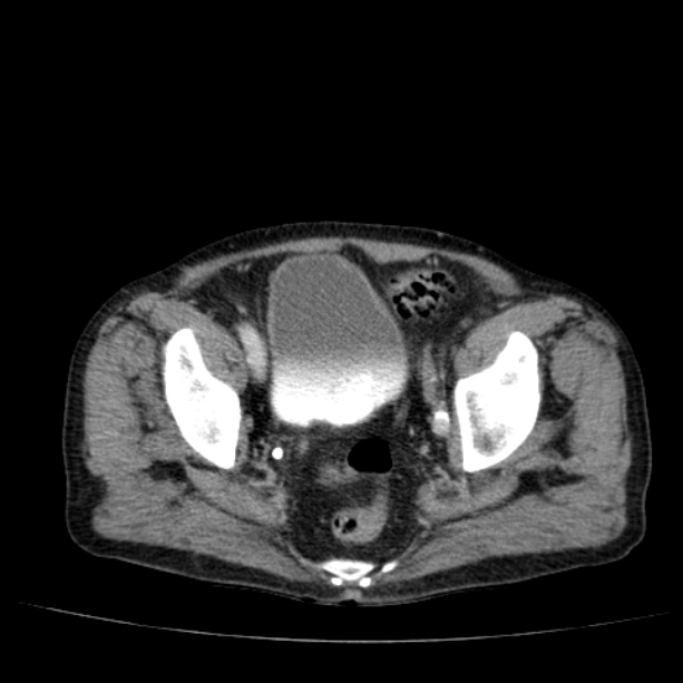Abdominal aortic aneurysm (Radiopaedia 29248-29660 Axial C+ portal venous phase 54).jpg