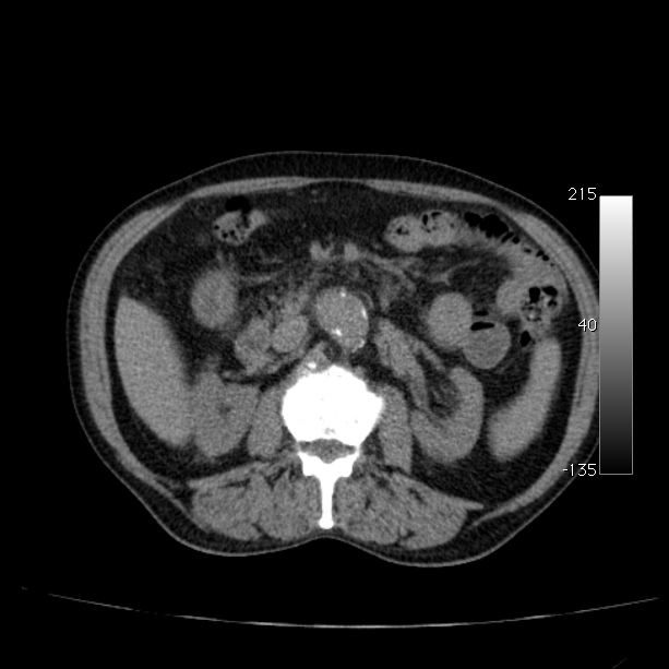 Abdominal aortic aneurysm (Radiopaedia 29248-29660 Axial non-contrast 24).jpg