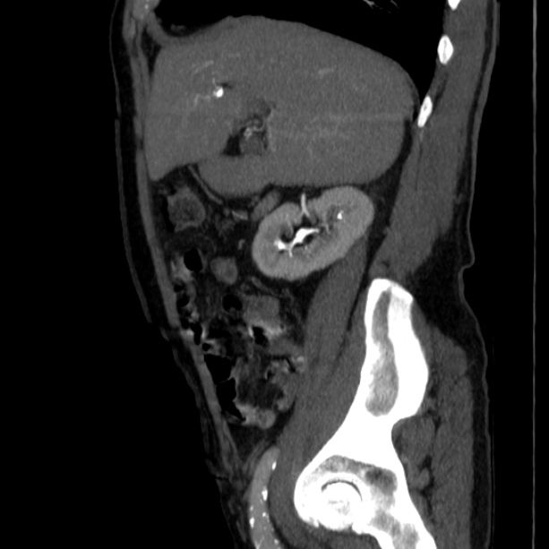 Abdominal aortic aneurysm (Radiopaedia 29248-29660 Sagittal C+ arterial phase 15).jpg