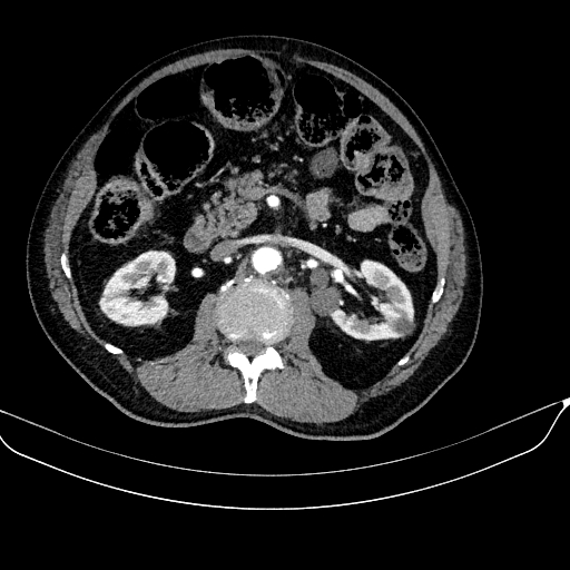 Abdominal aortic aneurysm (Radiopaedia 67117-76452 Axial C+ arterial phase 59).jpg
