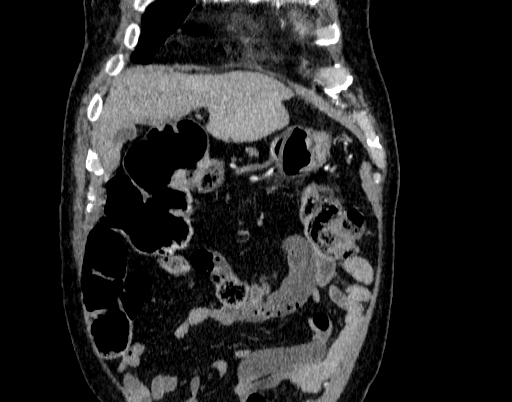 File:Abdominal aortic aneurysm (Radiopaedia 67117-76452 Coronal C+ arterial phase 1).jpg