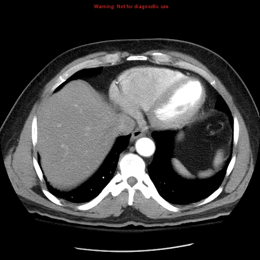 Abdominal aortic aneurysm (Radiopaedia 8190-9038 Axial C+ arterial phase 7).jpg
