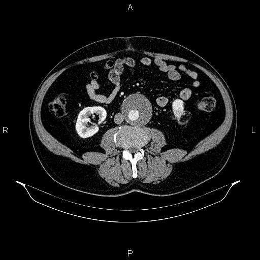 Abdominal aortic aneurysm (Radiopaedia 83094-97462 Axial renal cortical phase 107).jpg