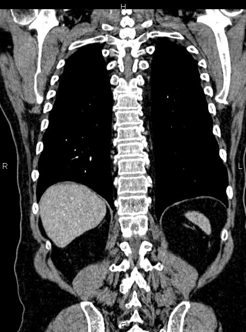 Abdominal aortic aneurysm (Radiopaedia 83094-97462 Coronal renal cortical phase 71).jpg