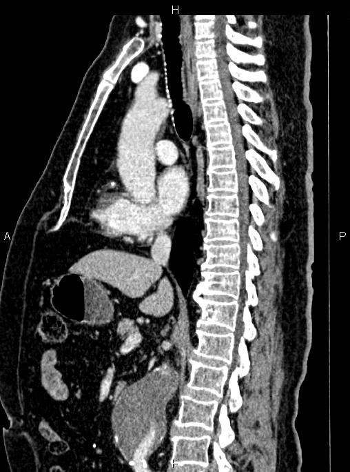 Abdominal aortic aneurysm (Radiopaedia 83094-97462 Sagittal renal cortical phase 63).jpg