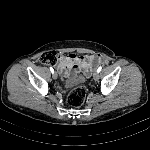 Abdominal aortic aneurysm (Radiopaedia 83581-98689 Axial C+ arterial phase 99).jpg
