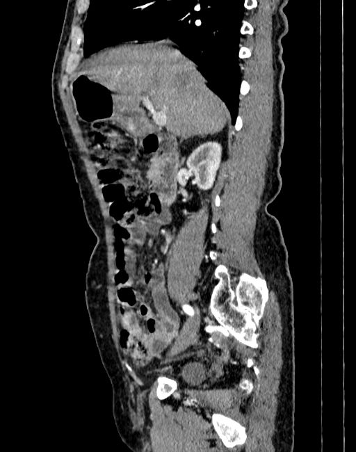 Abdominal aortic aneurysm (Radiopaedia 83581-98689 Sagittal C+ arterial phase 13).jpg