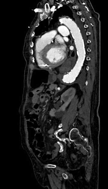 Abdominal aortic aneurysm with thrombus fissuration (Radiopaedia 73192-83919 Sagittal C+ arterial phase 49).jpg