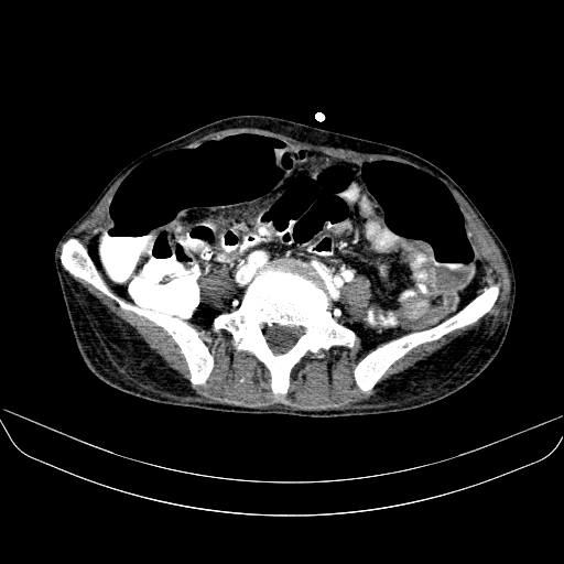 File:Abdominal collection due to previous cecal perforation (Radiopaedia 80831-94320 Axial C+ portal venous phase 134).jpg