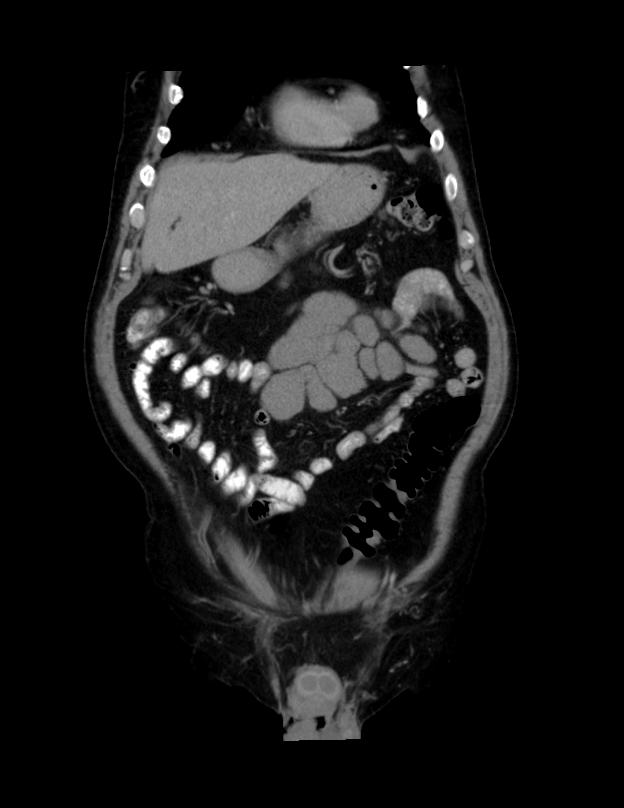 Abdominal lymphoma - with sandwich sign (Radiopaedia 53486-59492 C+ portal venous phase 45).jpg