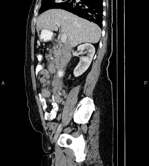 Abdominal lymphoma with sandwich sign (Radiopaedia 84378-99704 Sagittal C+ portal venous phase 28).jpg